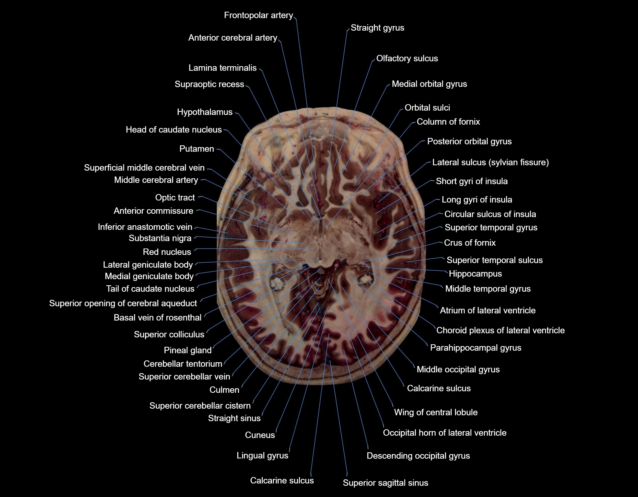 MRI Brain axial cross sectional radiology anatomy 3T image  -img-000038.webp